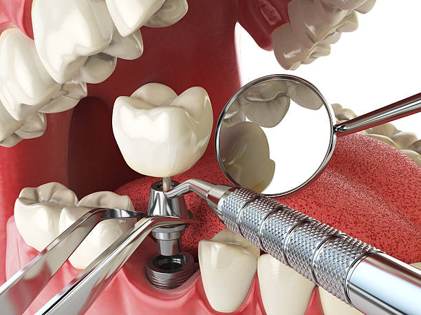 Best Lost Filling or Crown Replacement in Melcher Dallas, IA